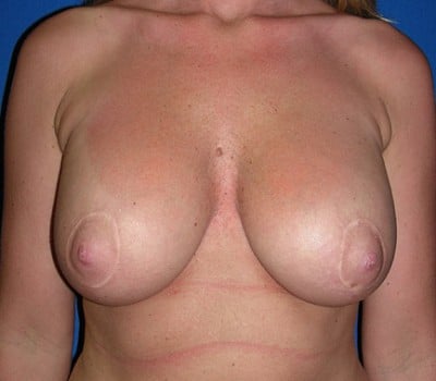 After Image: breast augmentation & lift - front