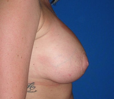 After Image: breast augmentation & lift - other
