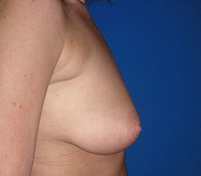 Before Image: breast augmentation & lift - other