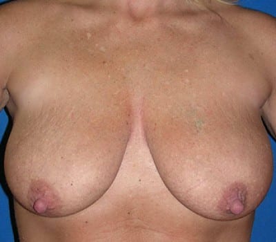 Before Image: 300cc silicone gel implants - front
