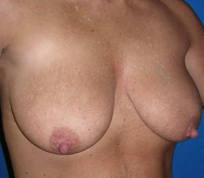 Before Image: 300cc silicone gel implants - other