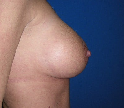 After Image: 300cc silicone gel implants - other