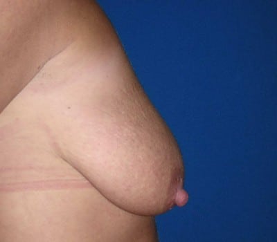 Before Image: 300cc silicone gel implants - other