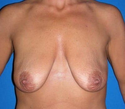 Before Image: improved breast position on toroso & size - front