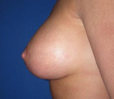 After Image: improved breast position on toroso & size - other