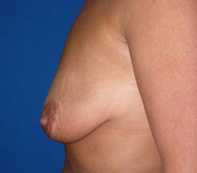 Before Image: improved breast position on toroso & size - other