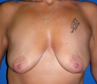 Before Image: improved contour and size - front