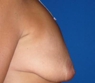 Before Image: improved contour and size - other