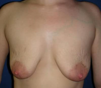 Before Image: Bilateral 275cc silicone gel implants - front