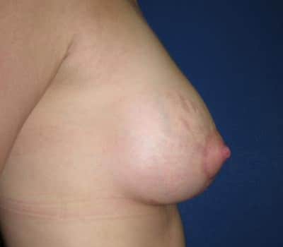 After Image: Bilateral 275cc silicone gel implants - other