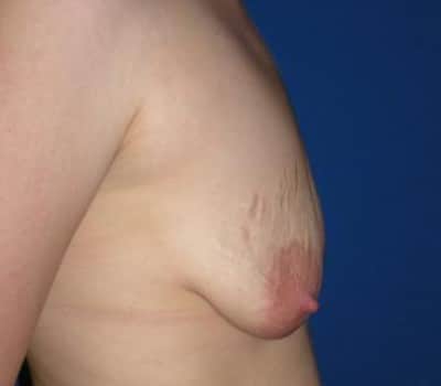Before Image: Bilateral 275cc silicone gel implants - other