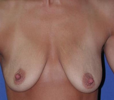 Before Image: bilateral breast lift with augmentation - front