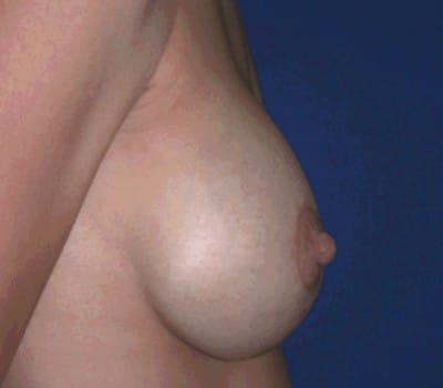 After Image: bilateral breast lift with augmentation - other