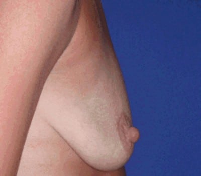 Before Image: bilateral breast lift with augmentation - other
