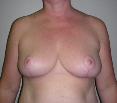 After Image: 44yo female 4 months after reducing the size of both breasts - front