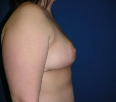 After Image: 27yo female 4 months after reducing the size of both breasts - other