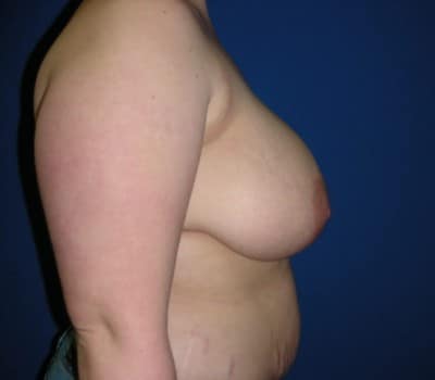Before Image: 27yo female 4 months after reducing the size of both breasts - other