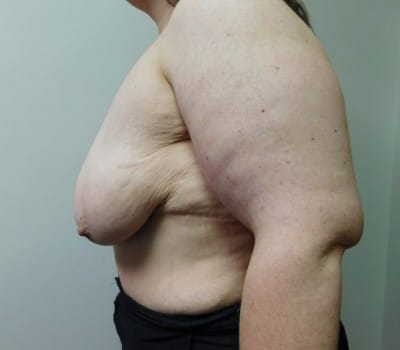 Before Image: 42yo after massive weight loss - other