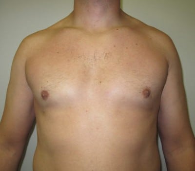 After Image: 38 yo gentleman who desired reduction in the size of his breasts - front