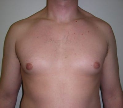 Before Image: 38 yo gentleman who desired reduction in the size of his breasts - front