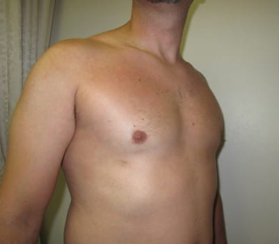 After Image: 38 yo gentleman who desired reduction in the size of his breasts - other