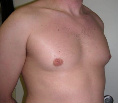 Before Image: 38 yo gentleman who desired reduction in the size of his breasts - other