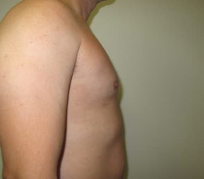After Image: 38 yo gentleman who desired reduction in the size of his breasts - front