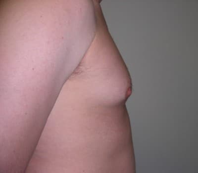 Before Image: 38 yo gentleman who desired reduction in the size of his breasts - front