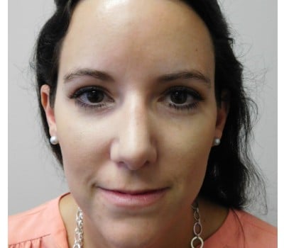 After Image: Rhinoplasty - front