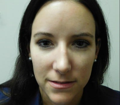 Before Image: Rhinoplasty - front