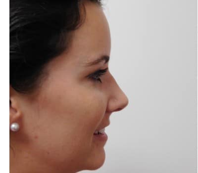 After Image: Rhinoplasty - other