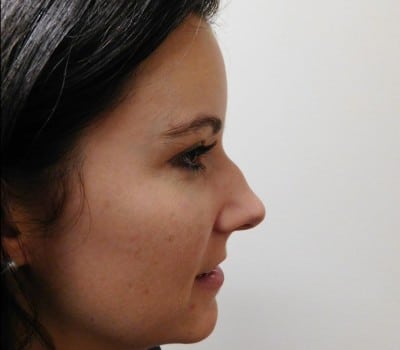 Before Image: Rhinoplasty - other