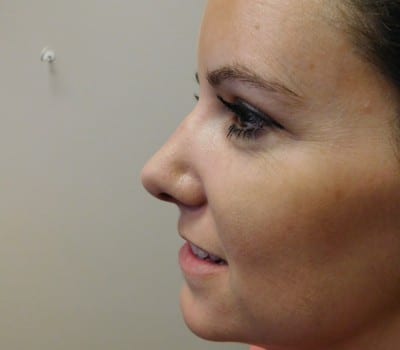 After Image: Rhinoplasty - other