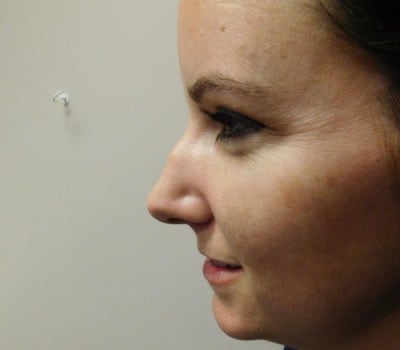 Before Image: Rhinoplasty - other
