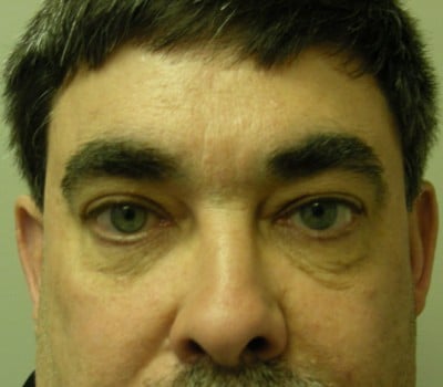 After Image: 56 yo Blepharoplasty w/transconjunctival incision - front
