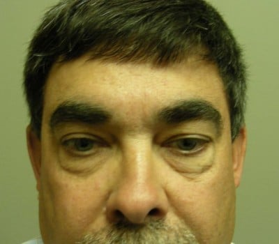 Before Image: 56 yo Blepharoplasty w/transconjunctival incision - front