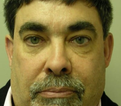 After Image: 56 yo Blepharoplasty w/transconjunctival incision - front