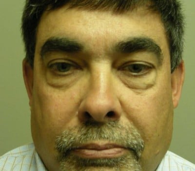 Before Image: 56 yo Blepharoplasty w/transconjunctival incision - front