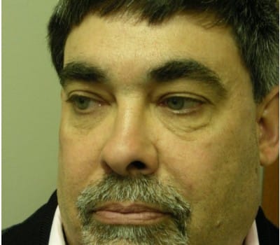 After Image: 56 yo Blepharoplasty w/transconjunctival incision - other