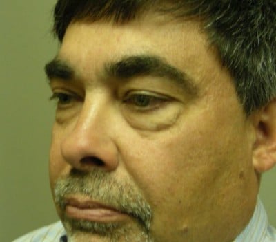 Before Image: 56 yo Blepharoplasty w/transconjunctival incision - other