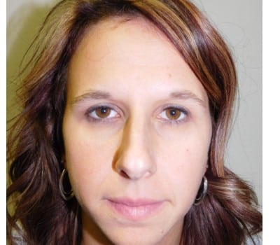 After Image: 38 Year Old upper blepharoplasty and endoscopic browlift - front