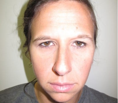 Before Image: 38 Year Old upper blepharoplasty and endoscopic browlift - front