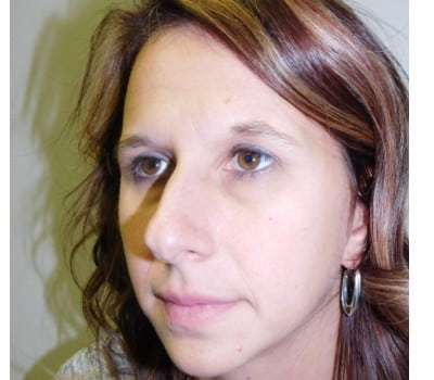 After Image: 38 Year Old upper blepharoplasty and endoscopic browlift - other