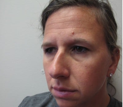 Before Image: 38 Year Old upper blepharoplasty and endoscopic browlift - other