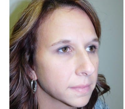 After Image: 38 Year Old upper blepharoplasty and endoscopic browlift - other