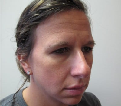 Before Image: 38 Year Old upper blepharoplasty and endoscopic browlift - other