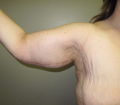 After Image: 42 Year Old Female Brachioplasty after weightloss - right-side