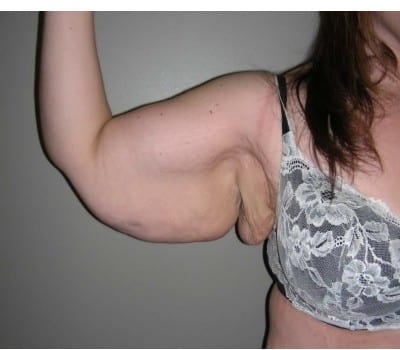 Before Image: 42 Year Old Female Brachioplasty after weightloss - right-side