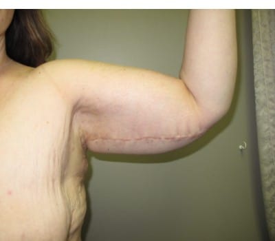 After Image: 42 Year Old Female Brachioplasty after weightloss - left-side