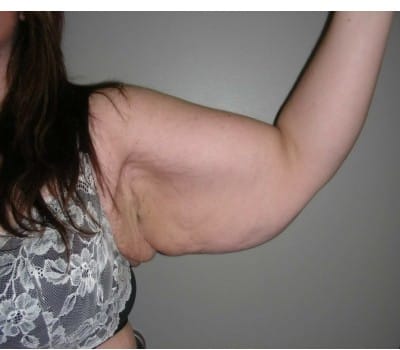 Before Image: 42 Year Old Female Brachioplasty after weightloss - left-side